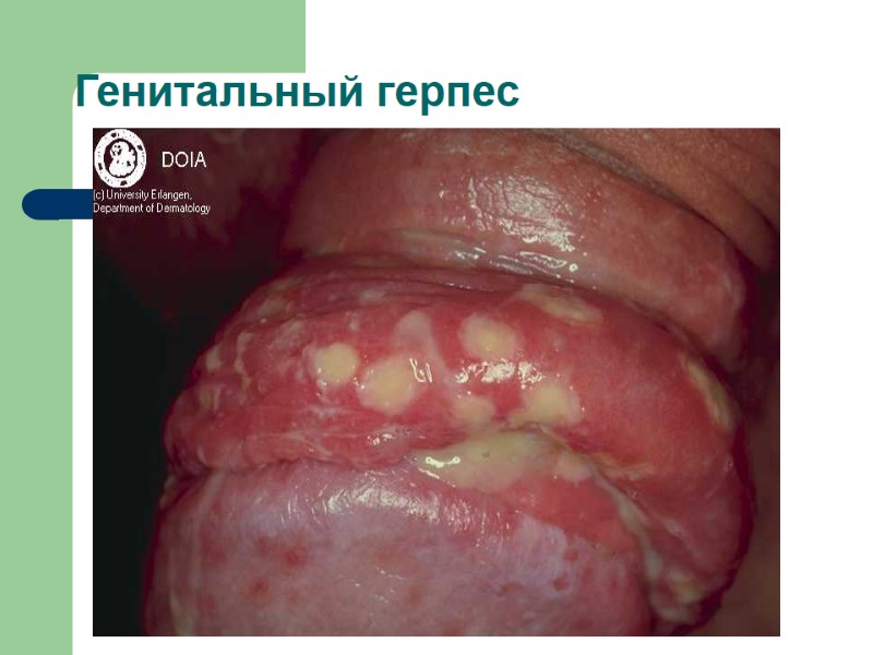 Генитальный герпес